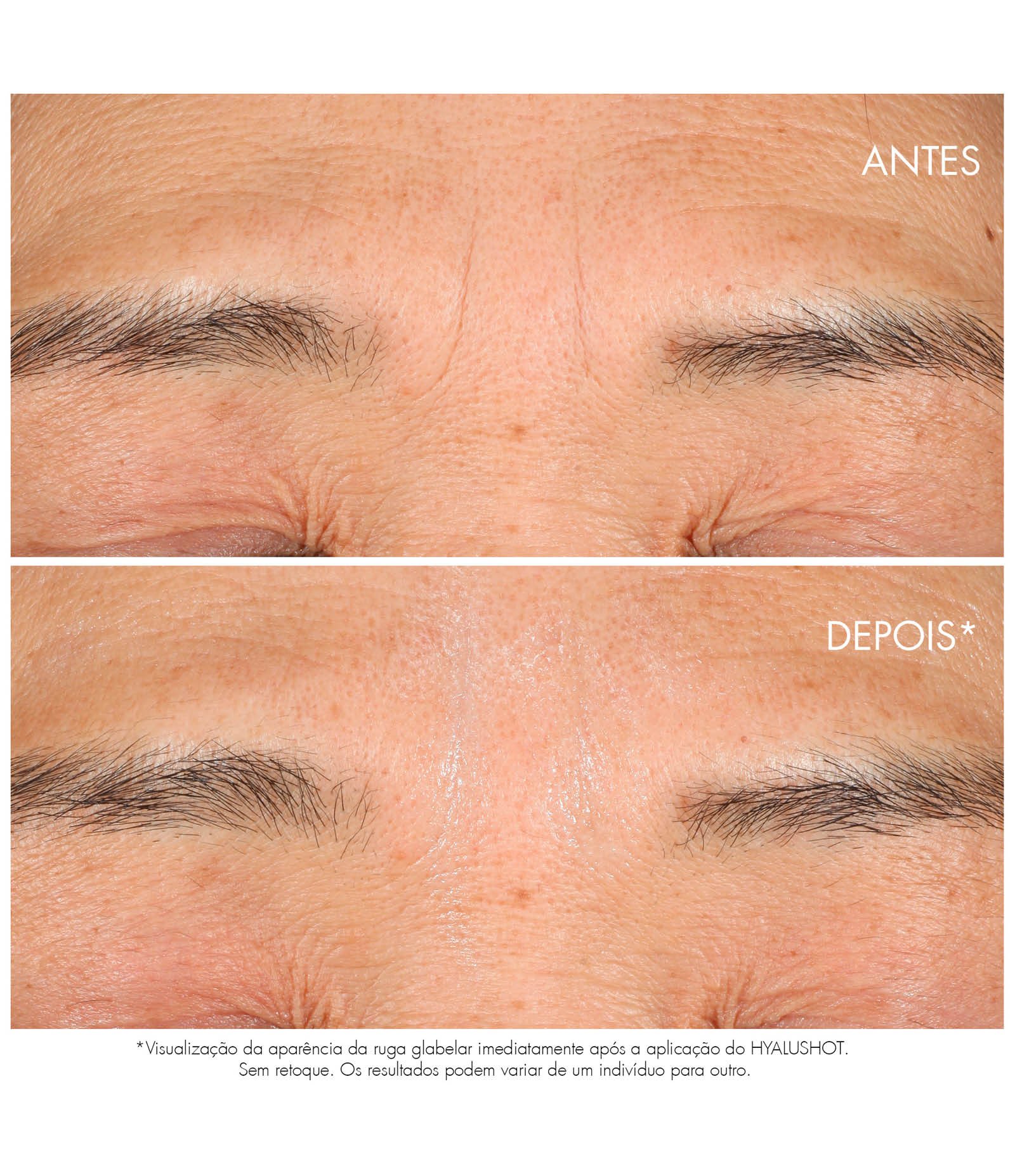 Capture Totale Hyalushot 15ml 15ml 6